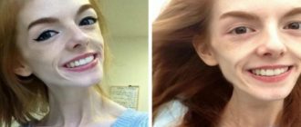 Mädchen mit Anorexie wurde von einem Schokoriegel geheilt