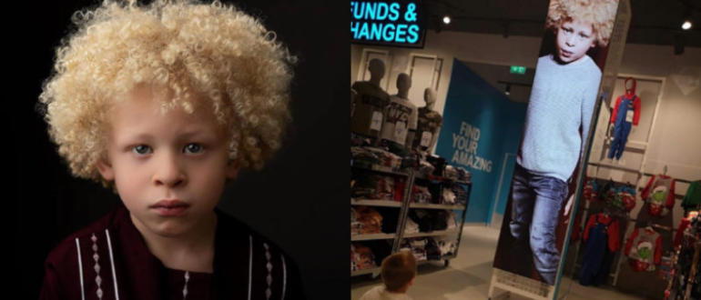 Der junge Albino-Junge wurde ein erfolgreiches Model