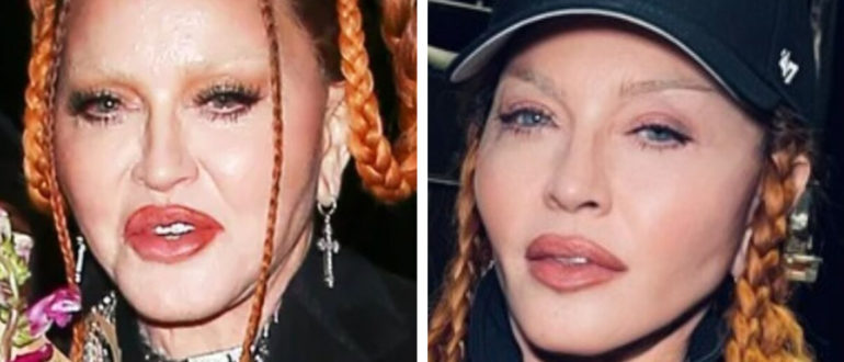 „Nicht mehr aufgedunsen, ich bin attraktiv!“  Madonna zeigte ihr Gesicht nach Schönheitsoperation