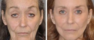 „Nicht mehr so ​​alt!“  Frauen im Rentenalter vor und nach plastischer Chirurgie