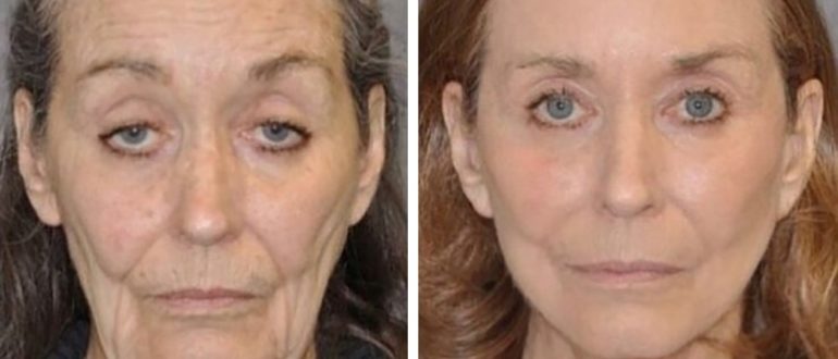 „Nicht mehr so ​​alt!“  Frauen im Rentenalter vor und nach plastischer Chirurgie