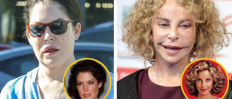 The Wrong Turn: Stars, die ihre Karriere wegen plastischer Chirurgie ruiniert haben