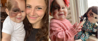 „Immer noch ein glückliches Lächeln im Gesicht“: Dieses entzückende Baby wurde wegen eines seltsamen Muttermals fast nie geboren