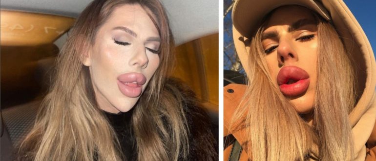 „Von einem gewöhnlichen Kerl zu einem Fremden“: Wie sah ein Friseur-Stylist aus der Provinz vor der plastischen Chirurgie und Transformation aus?